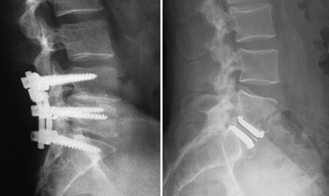 Side-by-side lateral lumbar spine X-rays showing spinal fusion hardware